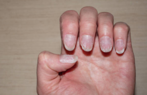 Damaged Nails